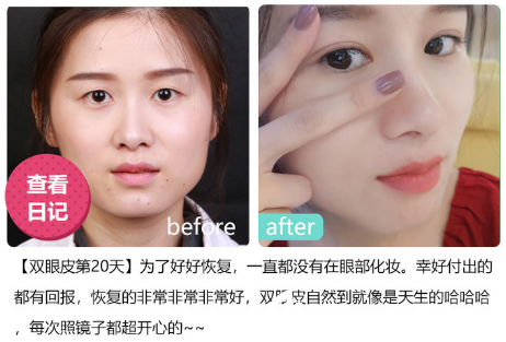 深圳美萊醫(yī)院林登文做的雙眼皮案例 深圳美萊醫(yī)院林登文做的雙眼皮案例