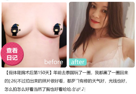 深圳美萊醫(yī)院郭杰做的假體隆胸哪里 深圳美萊醫(yī)院郭杰做的假體隆胸哪里