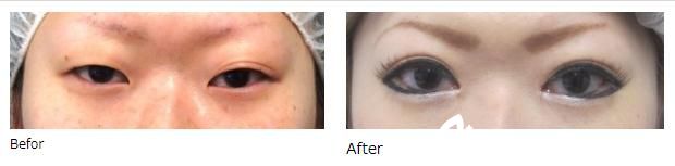 廣島美容外科醫(yī)院埋設(shè)法雙眼皮