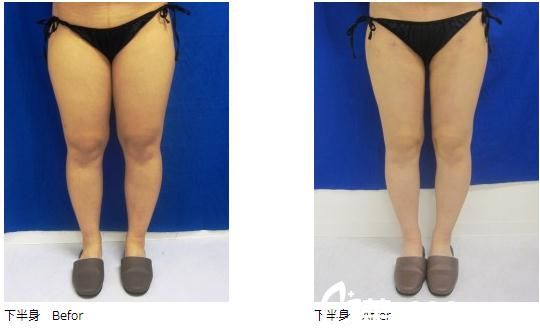 廣島美容外科醫(yī)院吸脂手術(shù) 廣島美容外科醫(yī)院吸脂手術(shù)