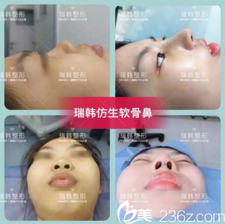 瑞韓仿生軟骨鼻術(shù)前術(shù)后效果對比 瑞韓仿生軟骨鼻術(shù)前術(shù)后效果對比