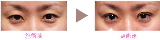 新垣形成外科醫(yī)院 埋設(shè)雙眼皮 新垣形成外科醫(yī)院 埋設(shè)雙眼皮