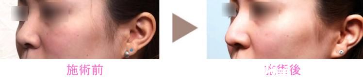 日本新垣形成外科醫(yī)院隆鼻 日本新垣形成外科醫(yī)院隆鼻