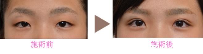 野村宏史埋線 野村宏史埋線