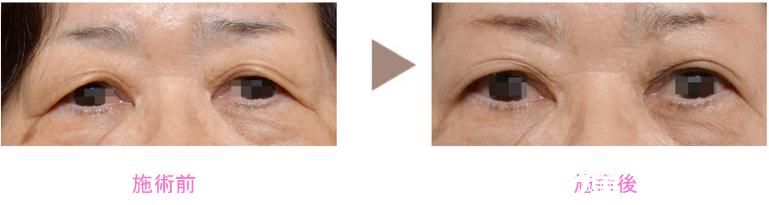 野村宏史 眼瞼下垂修正 野村宏史 眼瞼下垂修正