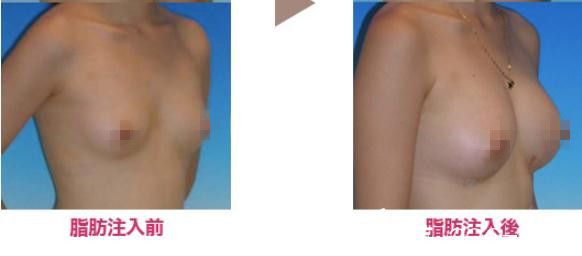 野村宏史脂肪豐胸 野村宏史脂肪豐胸
