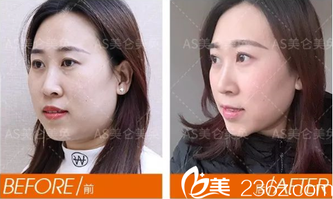 重慶美侖美奐面部提升案例