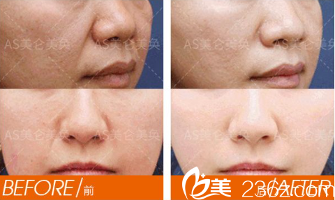 重慶美侖美奐去法令紋案例