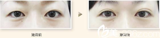 日本 TIARA 整形外科醫(yī)院雙眼皮手術(shù) 日本 TIARA 整形外科醫(yī)院雙眼皮手術(shù)