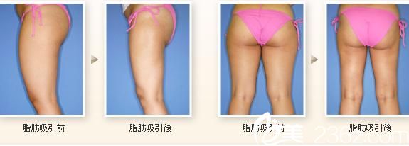 日本 TIARA 整形外科醫(yī)院 吸脂 日本 TIARA 整形外科醫(yī)院 吸脂