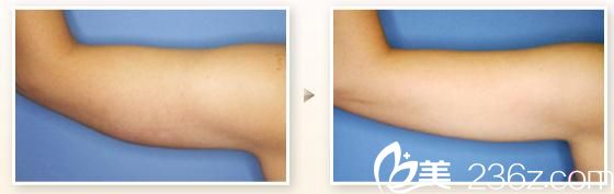 日本 TIARA 整形外科醫(yī)院 吸脂手術(shù) 日本 TIARA 整形外科醫(yī)院 吸脂手術(shù)