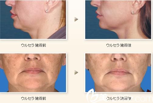 超音波美肌 超音波美肌