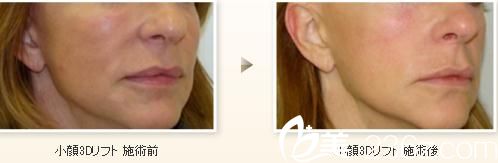 小臉3D提升術(shù) 小臉3D提升術(shù)