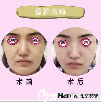 北京韓嘯醫(yī)院埋線提升多少錢(qián)？童顏線雕案例價(jià)格表參考