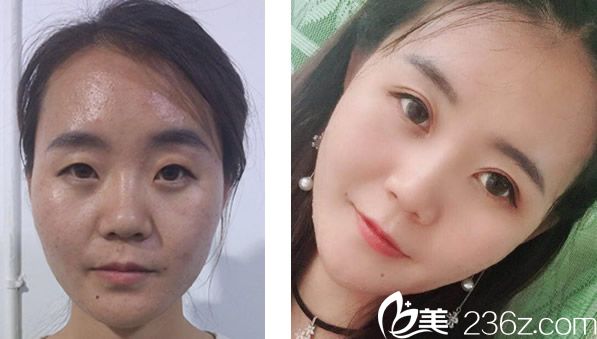 蘭州時(shí)光全切雙眼皮+開眼角+全臉脂肪填充效果對(duì)比圖