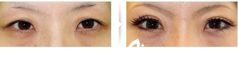切開法雙眼皮修復(fù)1 切開法雙眼皮修復(fù)1