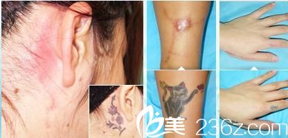 刺青傷疤去除 刺青傷疤去除