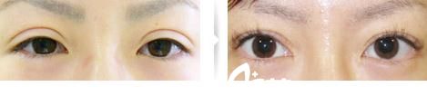 山本豐雙眼皮手術(shù)修復(fù)1