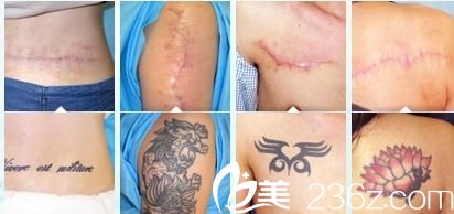 山本豐刺青傷疤去除