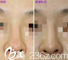 鼻中隔延長修復(fù)