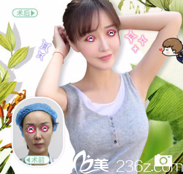 北京純脂馮斌脂整形王自謙醫(yī)生自體脂肪面部填充