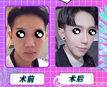 長沙協(xié)雅韓式芭比小翹鼻真人前后效果對比