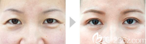 川崎整形醫(yī)院開眼角+雙眼皮手術(shù)2 川崎整形醫(yī)院開眼角+雙眼皮手術(shù)2