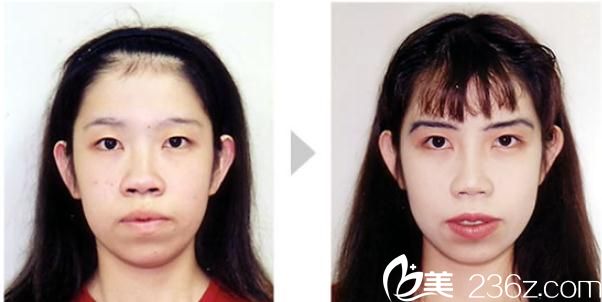 高牟禮隆鼻術(shù) 高牟禮隆鼻術(shù)