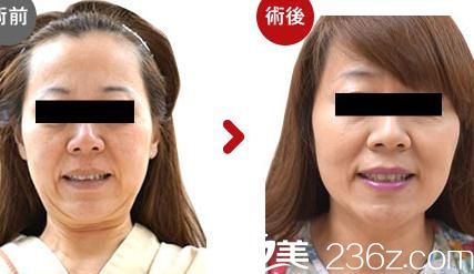 高牟禮線雕提升1 高牟禮線雕提升1