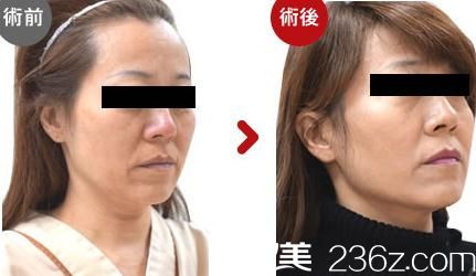 高牟禮線雕提升2 高牟禮線雕提升2