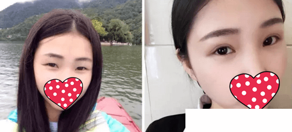 高清華醫(yī)生雙眼皮手術(shù)真人案例