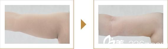 吸脂手術(shù)1 吸脂手術(shù)1