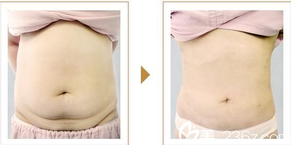 吸脂手術(shù)2 吸脂手術(shù)2