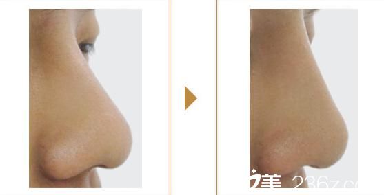 鼻部整形 鼻部整形