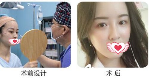 衡陽(yáng)美萊自體脂肪填充<span style=