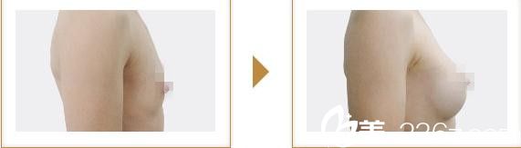 宮崎浩彥假體豐胸1 宮崎浩彥假體豐胸1