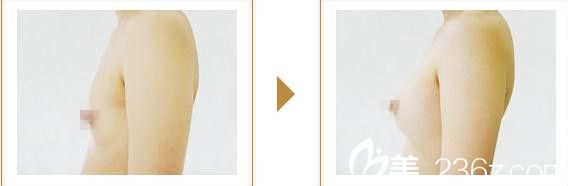 宮崎浩彥假體豐胸2 宮崎浩彥假體豐胸2