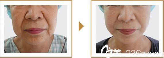 宮崎浩彥面部拉皮1 宮崎浩彥面部拉皮1