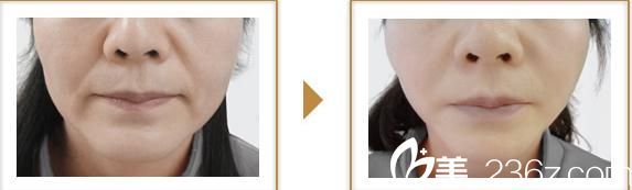 宮崎浩彥面部拉皮2 宮崎浩彥面部拉皮2