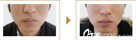 宮崎浩彥臉頰脂肪溶解注射 宮崎浩彥臉頰脂肪溶解注射