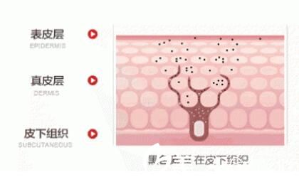 為什么肌膚會出現(xiàn)反黑現(xiàn)象?