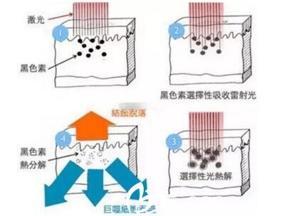 皮秒激光祛斑全程圖解過程示意圖