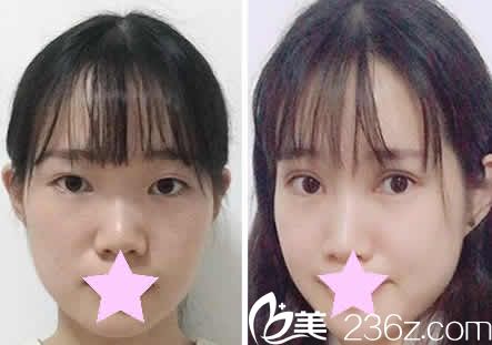 大同美神整形雙眼皮失敗修復(fù)案例圖 大同美神整形雙眼皮失敗修復(fù)案例圖