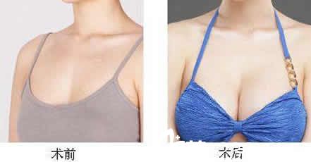 大同美神整形自體脂肪隆胸前后對比圖 大同美神整形自體脂肪隆胸前后對比圖