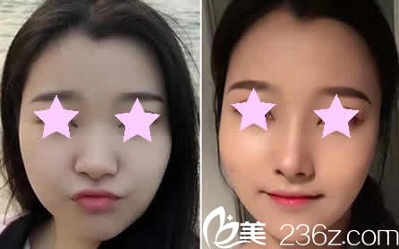 大同美神整形鼻綜合術(shù)后15天效果圖 大同美神整形鼻綜合術(shù)后15天效果圖