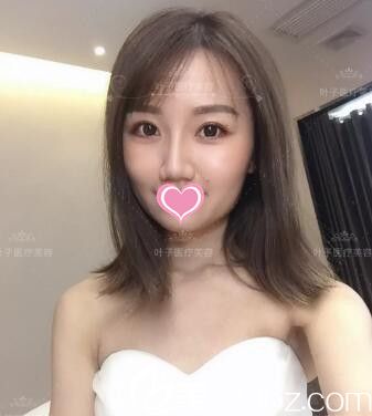 曾經(jīng)做雙眼皮失敗的我找整形醫(yī)院蔣新力幫我成功修復(fù)雙眼皮！