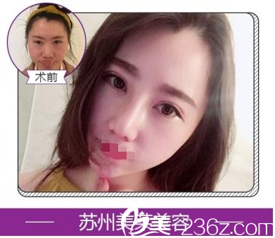 眼鼻整形案例 眼鼻整形案例