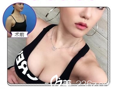 美萊隆胸案例 美萊隆胸案例