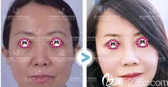 北京聯(lián)合麗格微拉美復(fù)合提升術(shù)多少錢？楊大平微拉美復(fù)合提升術(shù)8800元起附案例