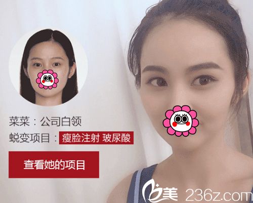 武漢藝星瘦臉案例